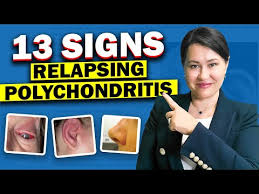 Image result for Relapsing Polychondritis