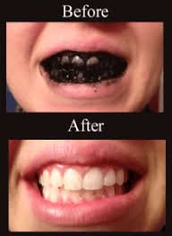 Jan 01, 2007 · 6 to 10 grams of xylitol a day. 4 Natural Teeth Whitening Options That Work Wellness Mama