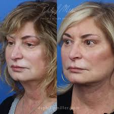 Neck Lift in New York City