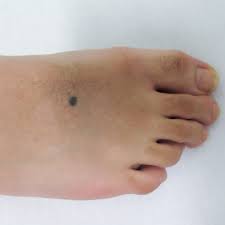 Image result for Blue Nevus
