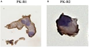 Prostate cancer (staging) prostate cancer staging takes into account tnm (primary site, nodal and distant metastases), pretreatment psa and histological … Prokineticin 1 Induces Normal Lymphangiogenic Activity And Is Involved In Lymphangiogenesis And Lymph Node Metastasis In Colorectal Cancer Oncotarget