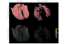 Cdc supports screening for breast, cervical, colorectal (colon), and lung cancers as recommended by the u.s. Inadequacies In Current Early Stage Lung Cancer Treatment Revealed Eurekalert Science News