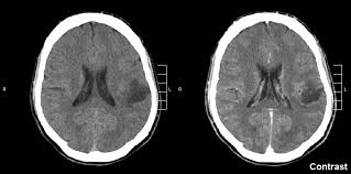 Check spelling or type a new query. A Cerebrospinal Fluid Test To Track Tumor Progression In Some Gliomas