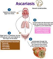 Ascariasis Ciri Ciri Gejala Dan Pengobatan Apa Itu Penyakit Ascariasis Apakah Anda Mengalaminya Dan Bagaimana Cara Pengob Kedokteran Kesehatan Penyakit