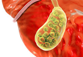 You can have one large gallstone, dozens to hundreds of imaging tests are used for that purpose, with ultrasound considered the test of choice; Gallstones Watch And Wait Or Intervene Consult Qd