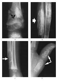 Image result for Osteomyelitis XRay