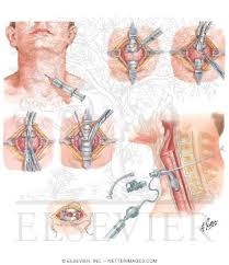 Tracheostomy Netter Medical Images Tracheostomy Medical Artwork Medical Illustration