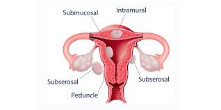 Uterine fibroid bleeding wreaks havoc on everyday life. About Uterine Fibroids Nichd Eunice Kennedy Shriver National Institute Of Child Health And Human Development