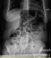 Image result for Sigmoid Volvulus