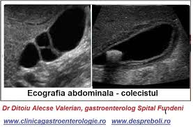 Cititi si articolul despre pietre la fiere si vezica biliara. Durerea De Fiere Criza De Fiere Cabinet De Gastroenterologie Bucuresti