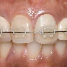 Black And Blue Braces Together The 26 Stages Of Getting Braces In 2020 With Images