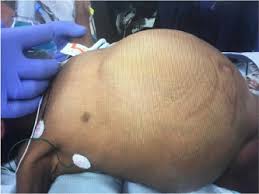 Laparoscopic Ventricular Cholecystic Shunt Sciencedirect