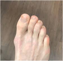 Image result for Tinnea apiculata