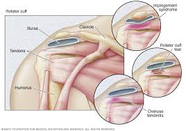 Image result for Rotator Cuff Rupture
