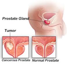 Prostate cancer stages and other ways to assess risk. Prostate Cancer Risk Factor Symptom Treatment Prevention How To Relief