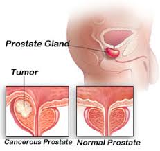 We list the stages below: Prostate Cancer Risk Factor Symptom Treatment Prevention How To Relief