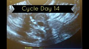 Follicle Tracking Ultrasound Cd 14 What Does This Mean