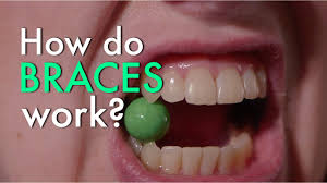 You can earn by taking paid surveys, participate in free contests, and invite friends to join. How Much Do Braces Cost For Adults And Teens Find Out Now