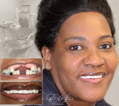 Dental implants are a wonderful option to consider for replacing missing teeth. Dental Implants Brooklyn Affordable Teeth Implants Implant Dentist