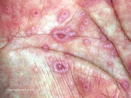 Image result for Erythema Multiforme Causes