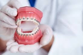 Achieving a Beautiful Smile with Braces: Your Guide to Orthodontic Care