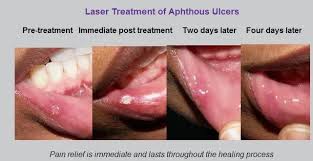 Image result for mouth ulcer on tongue)