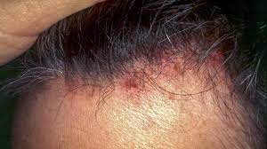 Keep your hair products gentle and rinse it well every time. Folliculitis Scalp Symptoms Pictures Shampoos And Other Treatments