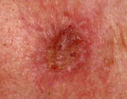 Lung cancer is a serious illness which none of us wish to face. Squamous Cell Carcinoma Skin Cancer Questions Answered Scary Symptoms