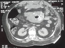 Diagnostic accuracy has been elevated by recent use of ultrasonography (us), . Benign Cystic Mesothelioma Of The Peritoneum A Case Report And Literature Review World Journal Of Emergency Surgery Full Text