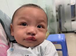 Over the past three weeks, the 2024 Dalhousie Cleft Lip and Palate mission  trip in Vietnam was an unforgettable experience. Representing Dalhousie  were our current staff Dr. JC Doucet and Dr. James