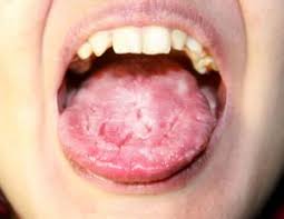 Image result for Fissured tongue