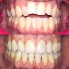 Just make sure that you are asking your doctor before using any of these methods. Overbite Invisalign Overbite Correction And Benefits How Does Overbite Affect You