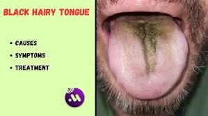 Image result for black hairy tongue symptoms