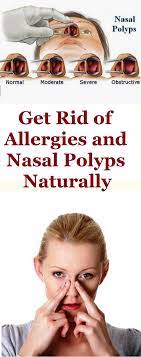 Get Rid Of Allergies And Nasal Polyps Naturally Nasal Allergies Remedies Polyp Nasal Allergies