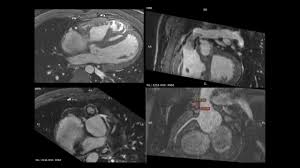 Image result for Cardiac MRI