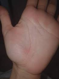 Blaschen Am Hand