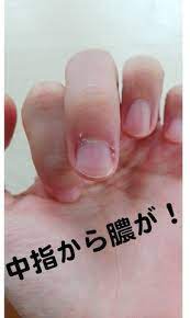 爪囲炎に効く市販薬はリンデロン 薬なしでも治る治療法を公開 カラダメグリズム part 5 爪 ほくろ除去クリーム オロナイン