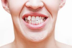 Oh man, bite blocks.that orthodontist is so annoying! Crooked Teeth Does Bad Childhood Habits Causes This