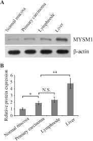 Squamous cell carcinoma stages represent the size of a tumor and how far it has spread. Plos One Expression Of Mysm1 Is Associated With Tumor Progression In Colorectal Cancer