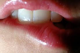 Herpes On Lips How To Cure 2013