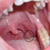 The infection is common among teenagers and young adults. 1
