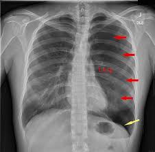 Image result for Pneumothorax