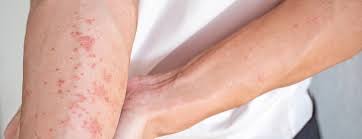 Image result for Keratosis pilaris