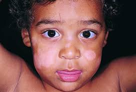 Pityriasis alba pityriasis alba is a common skin condition affecting mainly children and young adults and is thought to be related to eczema. Pityriasis Alba National Pharmarcy