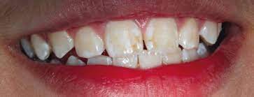 Hypomineralisation Or Hypoplasia British Dental Journal