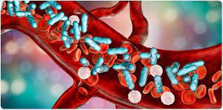 Sepsis affects you throughout your body. Diagnosi Di Sepsi