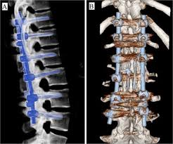 Image result for Chance Fracture