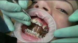 Cost of braces without insurance. How Much Do Braces Cost Golden Pediatric Dentistry Orthodontics