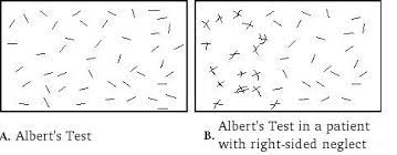 The schenkenberg line bisection test (schenkenberg et al., 1980), with a slightly improved alignment of the lines. Albert S Test Strokengine