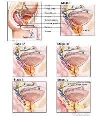 Find the information you need today. Prostate Cancer Medlineplus Genetics
